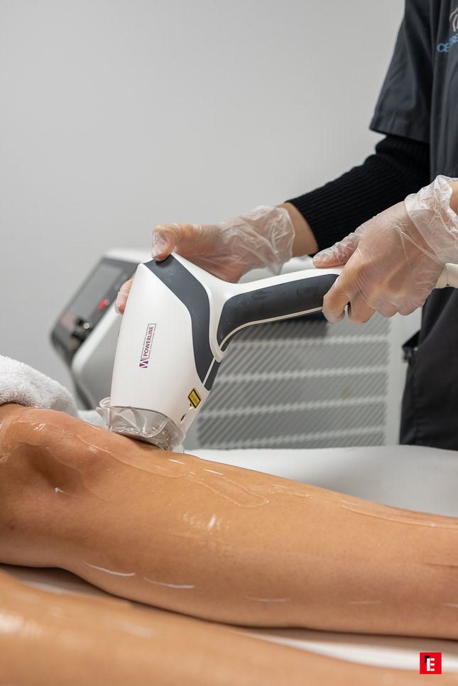 soin laser sur une jambe