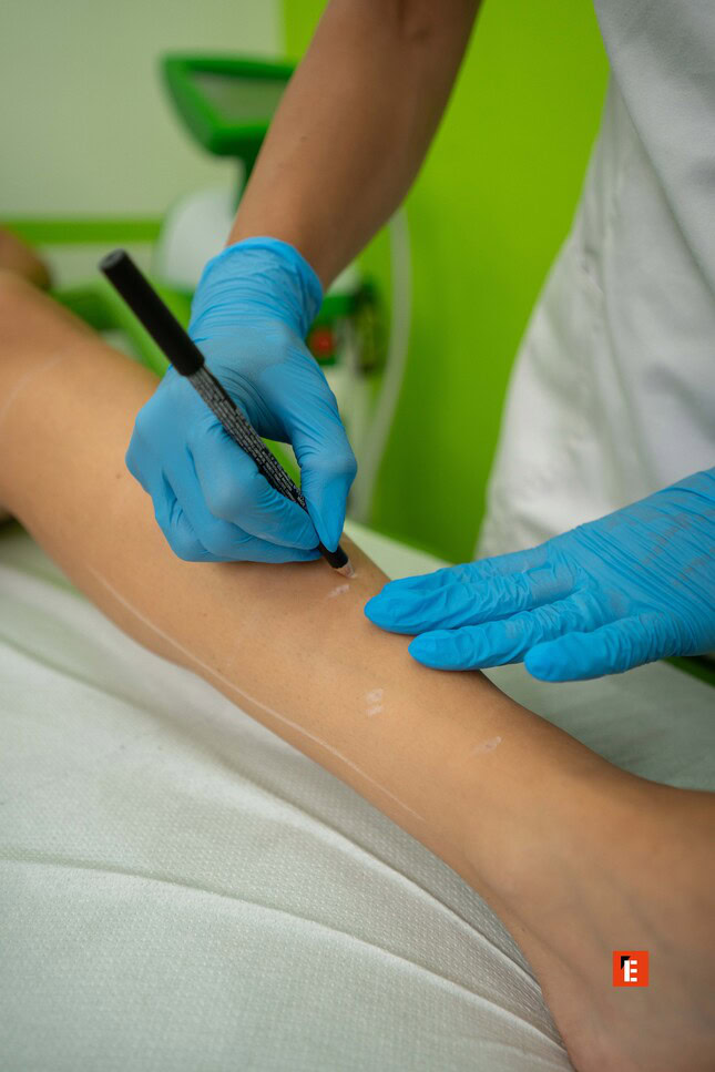 marquage médical précis sur jambe en clinique