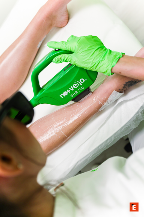 epilazione shr braccio con movelo shr 700