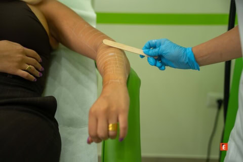 trattamento estetico braccio con marcature cliniche
